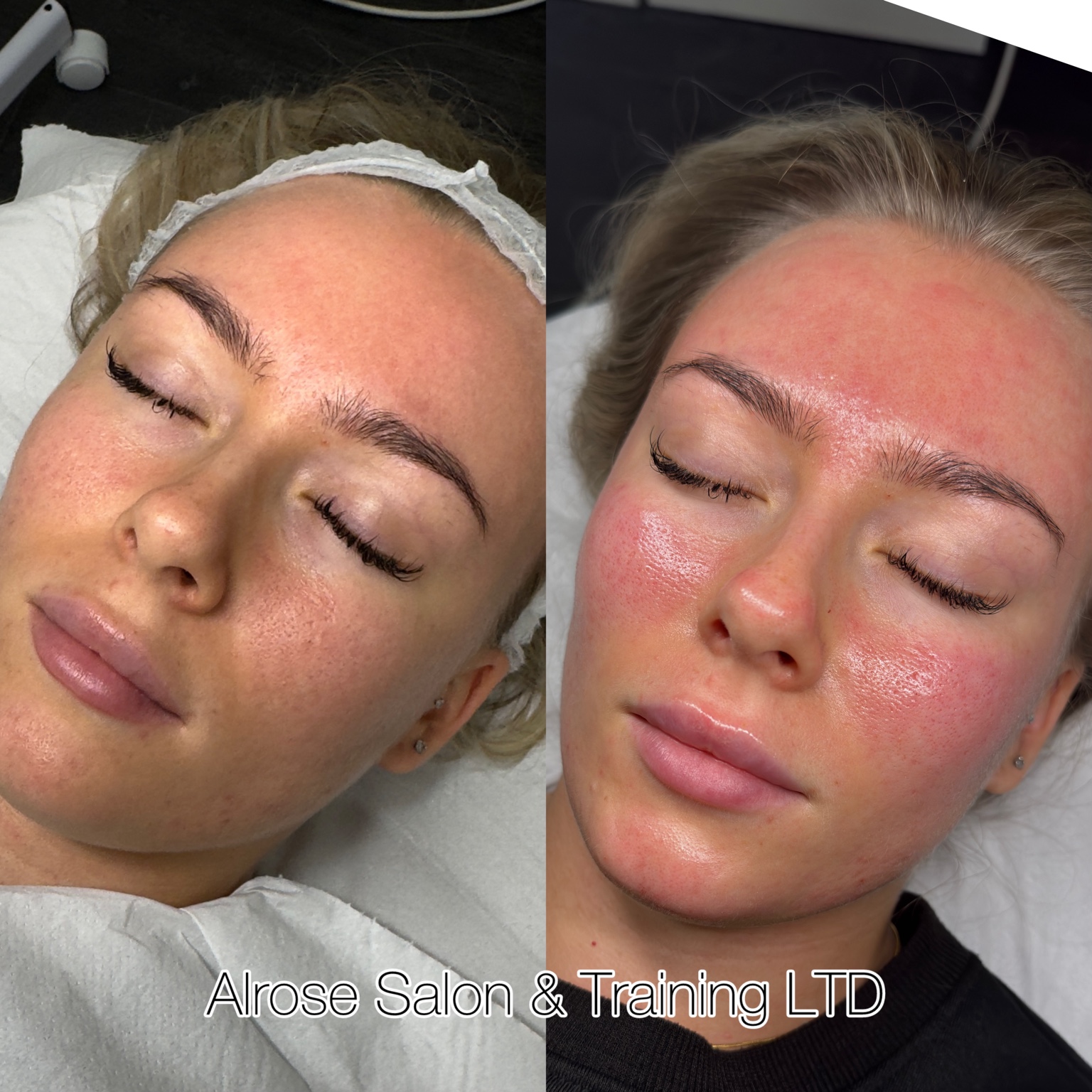 Alrose beauty treatment result